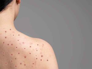 मंकीपक्सको संक्रमण फैलिएपछि स्वास्थ्य आपतकाल घोषणा